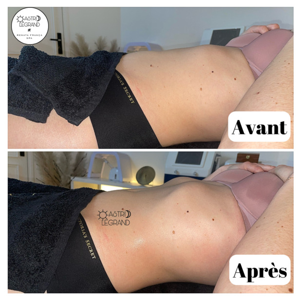 Astrid Legrand avant après renata franca massage drainant charleville reims 4