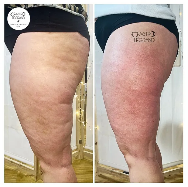 Astrid legrand madérothérapie cellulite avant après renata franca massage drainant charleville 2